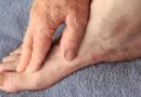 Grzybica stóp – objawy i przyczyny infekcji grzybiczej