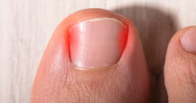 Wrastający paznokieć – przyczyny i skuteczne sposoby walki z tym problemem.